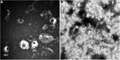 Exosomal miRNA-profiling of pleural effusion in lung adenocarcinoma and tuberculosis